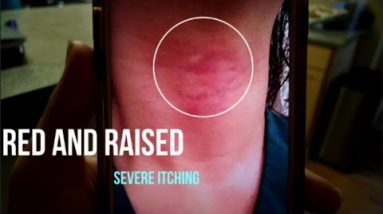 Eczema Struggle (Get Real with Me Vlog) 6 1680507186 hqdefault