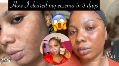 How to get rid of eczema in 3 days (with just one product, PICTURES INCLUDED) | that girl sekinah 4 1680512834 maxresdefault