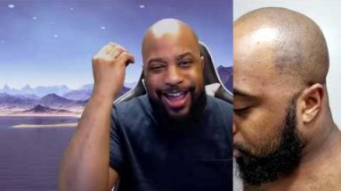 #749 - My Experience With Dyshidrotic Eczema | Shaving Razors Destroyed My Hands? 6 1680517442 hqdefault