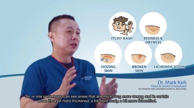 Ask the expert series - What are the signs and symptoms of eczema-prone skin in children? 18 1680519189 maxresdefault