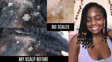 How I cleared Seborrheic Dermatitis & Healed my scalp (NOT SPONSORED) + Giveaway 8 1680522523 maxresdefault