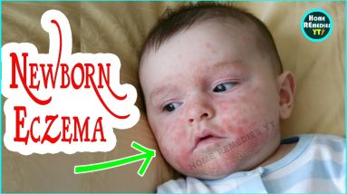 Newborn Eczema Causes and Symptoms - Baby Eczema 20 1680524148 maxresdefault