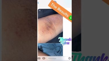 Eczema Soap 10 1680526913 maxresdefault