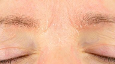 Why Do My Eyebrows Itch and Flake During the Winter? 4 1680528624 maxresdefault