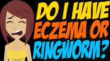 Do I Have Eczema or Ringworm? 12 1680531554 hqdefault