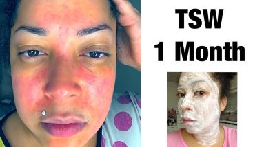 1 Month Withdrawing Topical Steroids | TSW 8 1680533368 maxresdefault