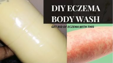 HOW TO MAKE ECZEMA BODY WASH(BATHING SOAP)|10 TIPS TO STOP THE ITCHING AND CLEAR UP ECZEMA|G G & YOU 20 1680535031 hqdefault