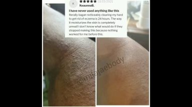 👀 Eczema Relief In 24 hours!!! 🌱 4 1680539894 maxresdefault