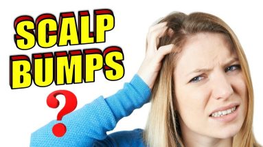 Why Do I Have Bumps on My Scalp | How To Get Rid of Scalp Acne & Folliculitis 18 1680541423 maxresdefault