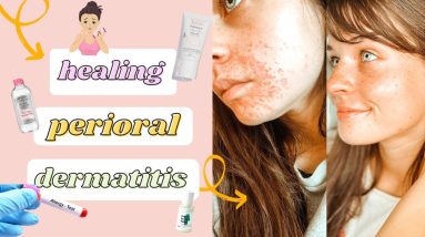 How I Healed My Perioral Dermatitis - What Works and What Doesn't + Product Recommendations 14 1680548115 maxresdefault