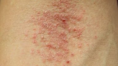 ECZEMA: HOW TO TREAT #TMITUESDAYS 14 1680559370 hqdefault