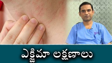 Eczema Symptoms and Causes part 2 | ఎక్జిమా లక్షణాలు, చికిత్స 20 1680563321 maxresdefault