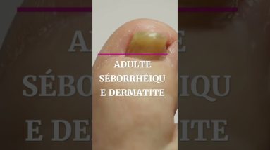 How to Treat Eczema and Get Rid of It 6 1680567077 maxresdefault
