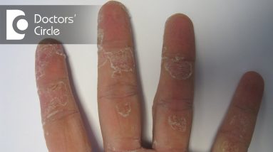 Causes of dry, affected small skin patch on hand - Dr. Aruna Prasad 20 1680568098 maxresdefault