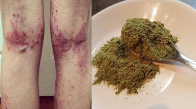How I got rid of my Eczema In 1 week!! 8 1680571843 maxresdefault