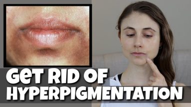 GET RID OF HYPERPIGMENTATION AROUND THE MOUTH| DR DRAY 18 1680574926 maxresdefault