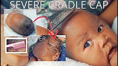 HOW TO GET RID OF ECZEMA + CRADLE CAP ON NEWBORN SCALP FAST!! | Bubs Bee 8 1680578351 maxresdefault