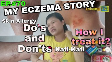 PAANO GAMUTIN ANG ECZEMA, SKIN ALLERGY, O KATI KATI SA BALAT - causes, symptoms, and treatment 4 1680579086 maxresdefault