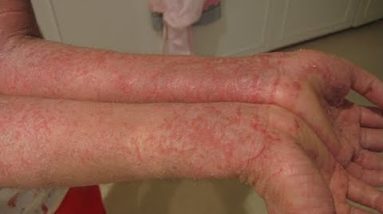Vinegar for Eczema 12 1680582704 hqdefault