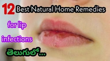 Best Home Remedies for Lip Infections | Lip Infection Natural Home Remedies | Lip care Tips 10 1680587610 hqdefault