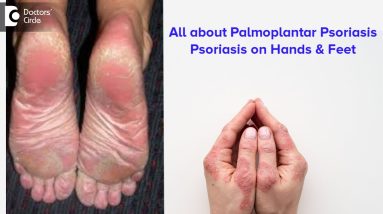 All about Palmoplantar Psoriasis | Psoriasis on hands & feet - Dr. Rajdeep Mysore | Doctors' Circle 6 1680589850 maxresdefault