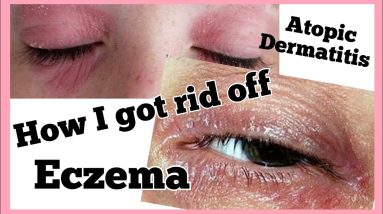 Dermatitis/ Eczema | How I got read off | Dannah Rey 16 1680598127 maxresdefault