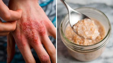 How to Cure Eczema Naturally 14 1680598307 maxresdefault