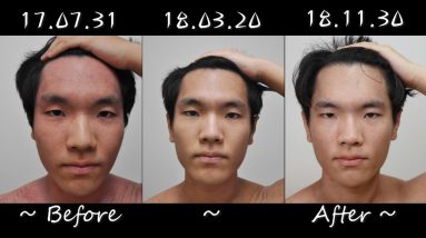 만성 성인 아토피피부염 치료 기간 !! - 아토피 회복 주기 파헤쳐 보기 (+여드름, 지루성피부염 등. 비교 사진 수천 장 대공개) 10 1680598710 maxresdefault