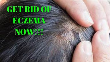 how to get rid of eczema on scalp 20 1680602243 maxresdefault