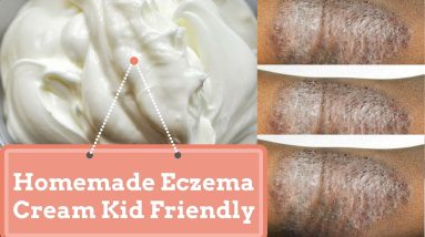 Homemade Eczema Cream Kid Friendly 12 1680603668 maxresdefault
