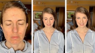 How to Cover Up Eczema, Cold Sores, Psoriasis and Other Skin Conditions 12 1680615088 hqdefault