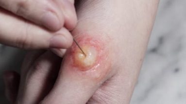 Popping a Giant Blister/Abscess 4 1680624678 hqdefault