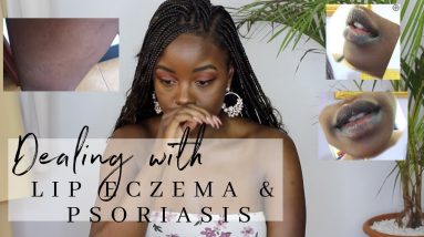 Eczematous Cheilitis Lip Eczema Update & Dealing with Psoriasis Now! 10 1680634194 maxresdefault