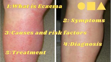 Eczema Symptoms Causes And Risk Factors/Diagnosis & Treatment | Patches On Skin 8 1680634263 maxresdefault