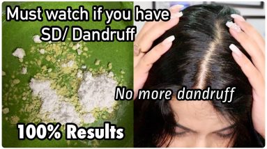 Current Scalp & Hair Situation | BEST SEBORRHEIC DERMATITIS TREATMENT |Best Home Remedy for Dandruff 8 1680639956 maxresdefault