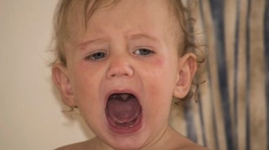Atopic Eczema Natural Treatment Stop Itch 4 1680642447 maxresdefault