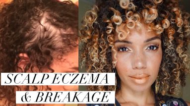 SCALP ECZEMA & NAPE BREAKAGE | Remedies/ Natural Products 20 1680643133 maxresdefault
