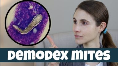 DEMODEX MITES ON YOUR SKIN| DR DRAY 14 1680644127 maxresdefault