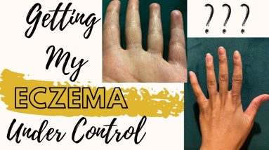 How to Deal with Eczema | What Inflames It (With Pictures 🎥) 4 1680647225 maxresdefault