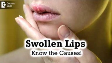 Swollen Lips: Common Causes,Triggers | Angioedema - Dr. Rashmi Ravindra | Doctors' Circle 20 1680647890 hqdefault