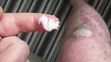 Coconut Oil for Psoriasis and Eczema (moisturiser and bath routine!) 20 1680654333 maxresdefault