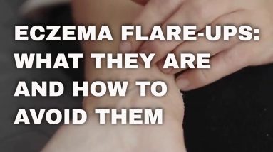 Atopic Dermatitis On Face. Eczema Flare-Ups: What They Are And How To Avoid Them 2 1680659539 maxresdefault