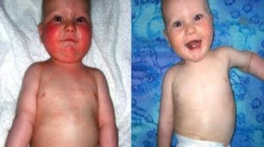 how to help your child with eczema - eczema home remedy 12 1680672912 hqdefault