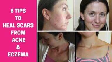 How to heal acne and eczema scars and get glowing skin 14 1680688561 maxresdefault