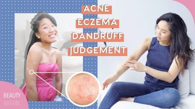 How We Dealt With Acne, Eczema, Dandruff 🌻 Our Biggest Skin & Beauty Insecurities 12 1680694678 maxresdefault