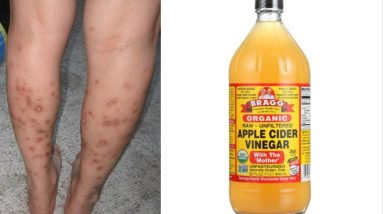 Home Remedies Series || Get Rid of Dark Spots On Legs & Body With Apple Cider Vinegar 18 1680698396 maxresdefault