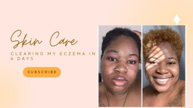 Eczema: How to Treat & Get Rid of it|How To Clear Eczema Acne Psoriasis in 6 Days| Skin Remedies 18 1680703220 maxresdefault