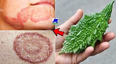 Fungal infection treatment - Herpes, eczema will relieve itching in 7 days - Ringworm treatment 18 1680709680 maxresdefault