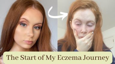 LIVING WITH ECZEMA VLOG 1 // ECZEMA FLARE UP & DOCTORS APPOINTMENT 10 1680710855 maxresdefault