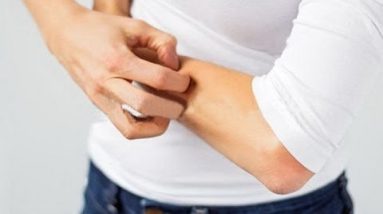 How to Treat Eczema : Eczema Symptoms and Causes 8 1680711385 hqdefault